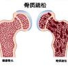 骨质疏松图片7