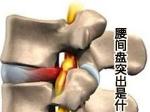 腰间盘突出图片