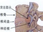 腰间盘突出示意图