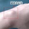 腱鞘炎症状图片1