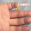 手指腱鞘炎图片1