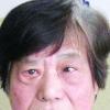 白内障早期图片7