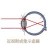 近视眼成像示意图1