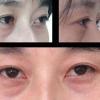 近视眼眼睛变形图片3