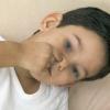 小孩鼻息肉图片6