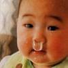 小孩鼻息肉图片5