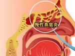 慢性鼻窦炎图片