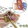 中耳炎图解2
