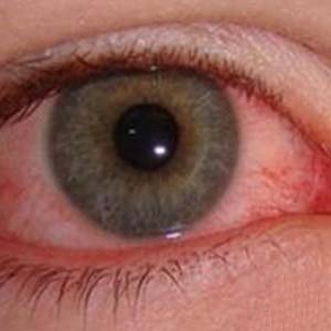 青光眼早期症状有哪些?