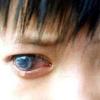 青光眼的早期症状图片2