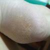 脚底硬皮病图片5