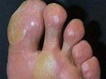 脚底硬皮病图片